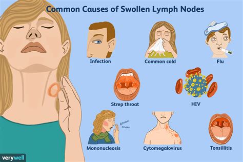 Thyroid Gland, Thyroid Hormone, Dental Infection, Synthroid, Swollen Lymph Nodes, Levothyroxine ...