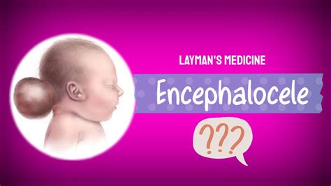 Encephalocele//Neural Tube defect//Congenital disorders// animated ...