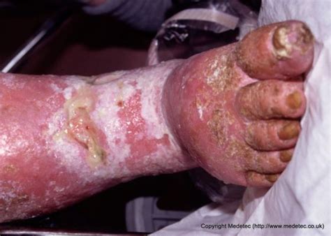 A heavily exuding leg ulcer showing maceration of periwound skin