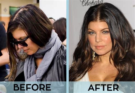 31 Celebrities With Hair Transplant | Before & After Photos