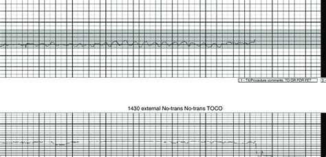 Fetal heart rate tracing demonstrating a sinusoidal fetal heart rate ...