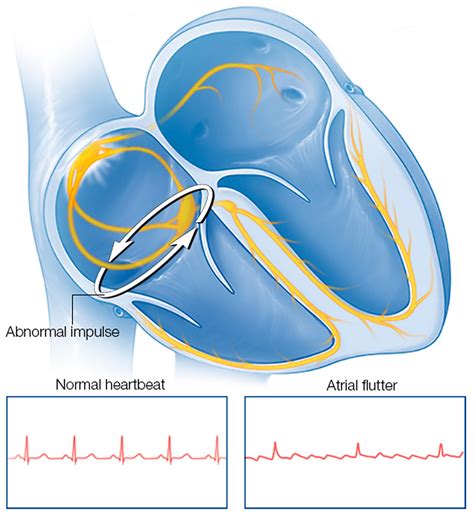 Atrial Flutter - Causes, Symptoms, Treatment & Ablation