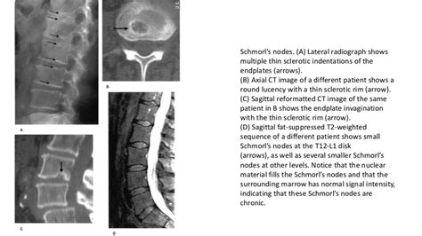 Imaging of lumbar spondylosis