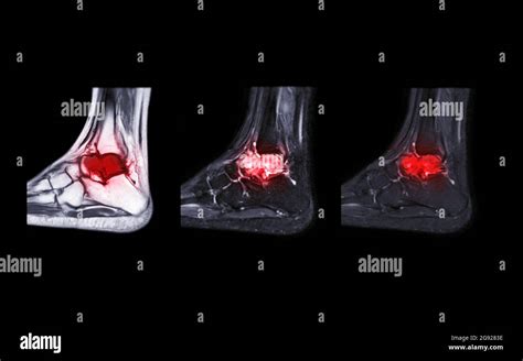 Compare of mri ankle joint sagittal view for diagnosis tendon of ankle joint injury Stock Photo ...