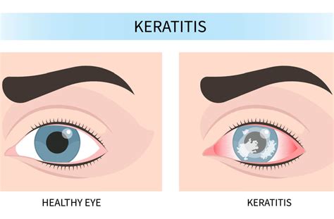 Neurotrophic Keratitis: Causes, Symptoms and Treatment