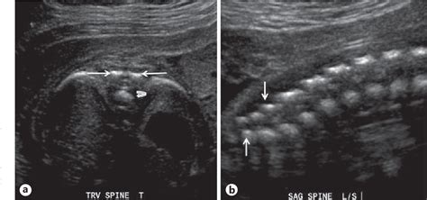 Figure 31 from The Diagnostic Features of Spina Bifida: The Role of ...