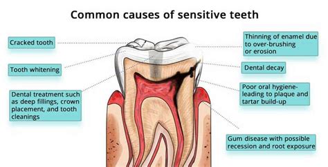 Tooth Sensitivity: Causes, Treatment, and Prevention