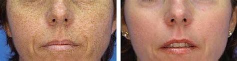 Laser Freckle Removal Clinic | Laser Treatment For Freckle