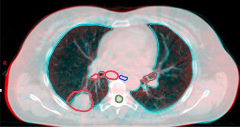 Cone Beam Ct In Radiotherapy - The Best Picture Of Beam