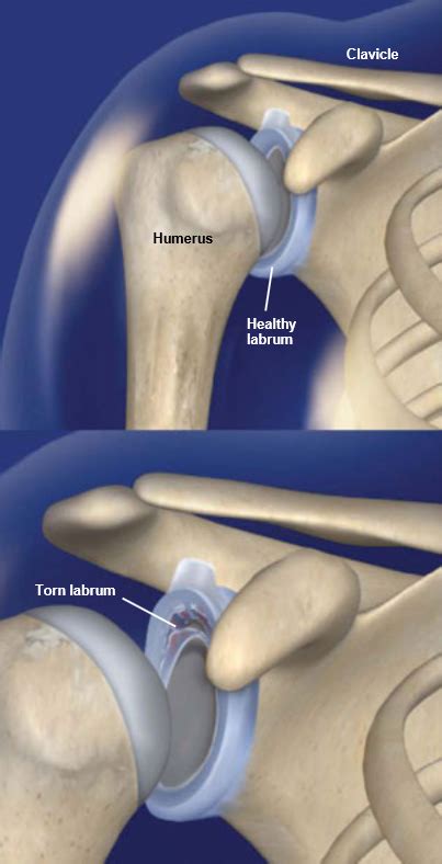 Glenoid Labrum Tears | Central Coast Orthopedic Medical Group