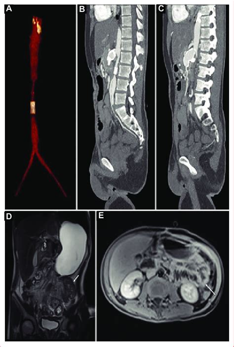 Radiographic findings. A: abdominal CT angiography shows decreased... | Download Scientific Diagram