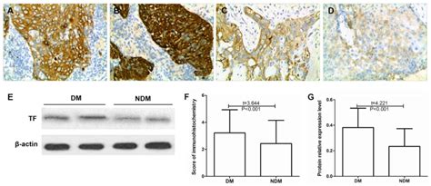 Expression of tissue factor in human cervical carcinoma tissue