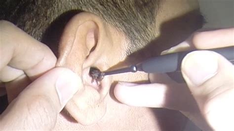 Man's Massive Ear Wax Extraction - YouTube