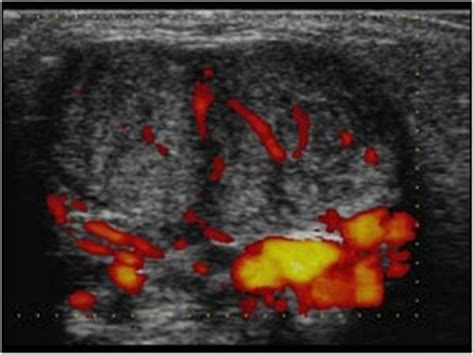 Pediatrics | 9.5 Pediatric head and neck : Case 9.5.4 Miscellaneous head and neck | Ultrasound Cases