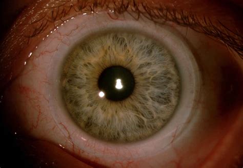 Lecture: Scleral Lens Assessment and Fitting – Cybersight