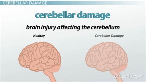 Cerebellar Damage: Symptoms & Treatment - Lesson | Study.com