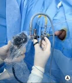 Dr Tim Nathan Urology | Transurethral Incision of Prostate (TUIP)