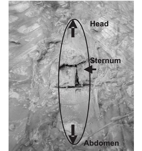 Typical injury (sternal fracture). | Download Scientific Diagram