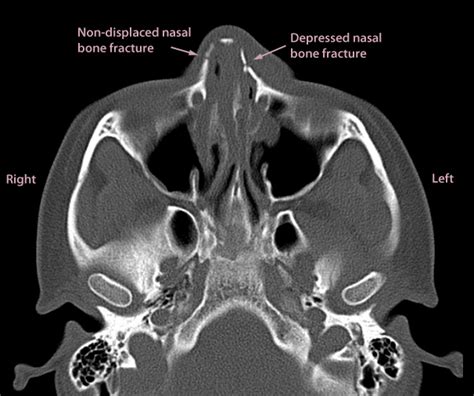 Nasal Bone Fracture Radiology Ct / PPT - Radiology of The Ear PowerPoint Presentation - ID ...