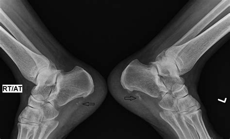 Calcaneal Spur Xray