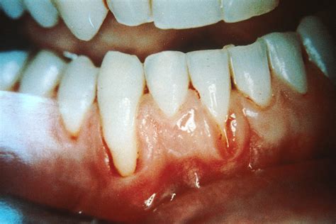 Bleeding gums treatment | General center | SteadyHealth.com