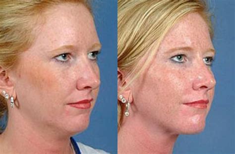 Neck Procedures Before & After Photos Patient 111 | Louisville, KY | CaloSpa® Rejuvenation Center