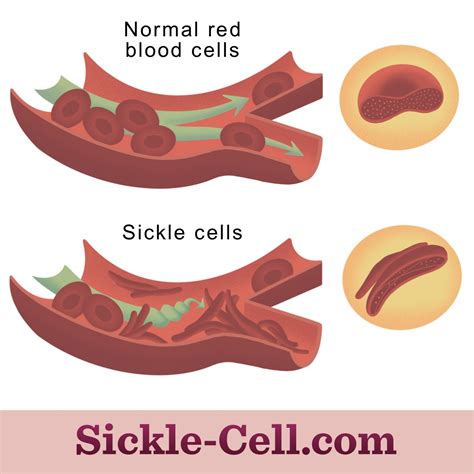 Sickle Cell Pain Crises and Causes