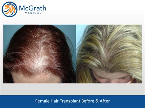 female fue hair transplant before and after - Jetta Mccullough