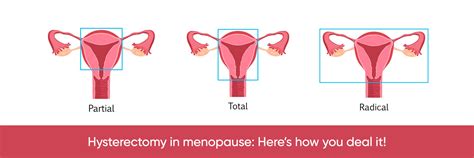 Hysterectomy In Menopause: Here's How You Deal It!