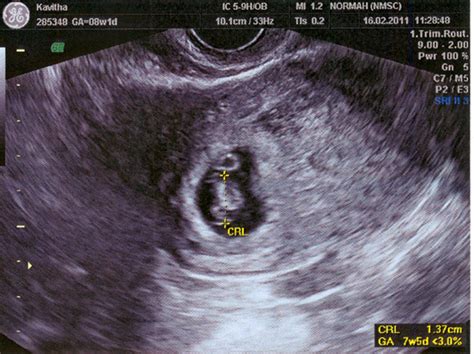 Ruthies's Journal: 8 Weeks Ultrasound Scan Photos