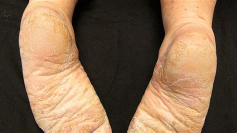 Plantar and Palmar Psoriasis: Treatment and More