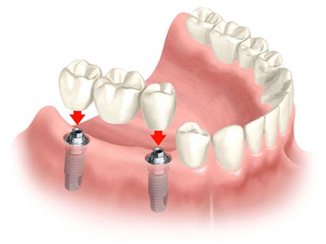 How to take care of a tooth bridge - LetsFixIt