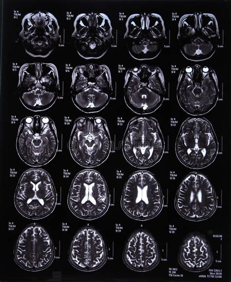 MRI scan image of brain stock photography | Mri scan, Brain images ...