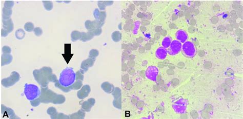 A -Peripheral blood smear showing blasts (arrow). (Leishman's stain,... | Download Scientific ...