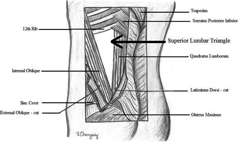 Repair of a Traumatic Lumbar Hernia With Biosynthetic Mesh: A Novel ...