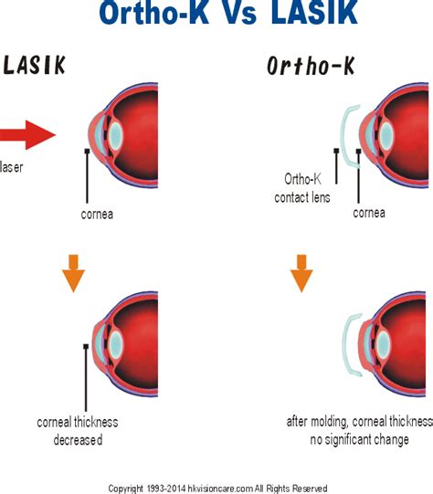 Ortho K vs Lasik - VIO Optical Clinic