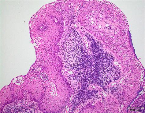 Craniopharyngioma Histology