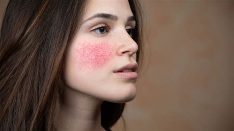 Facial Redness: Causes, Symptoms & Treatments