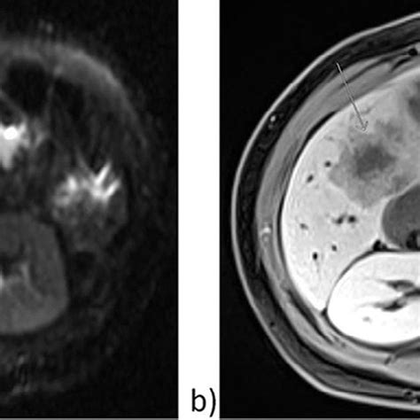 MRI: (A) Axial diffusion-weighted image demonstrates restricted ...