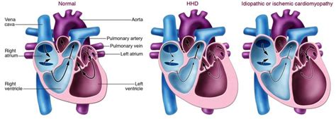 JCI - ECM remodeling in hypertensive heart disease