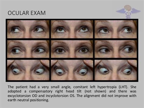 Ocular tilt reaction and skew deviation