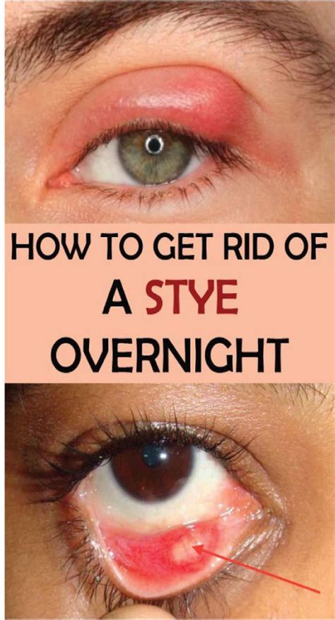 How To Get Rid Of A Stye Overnight – 34 Home Remedies | Healthy Greens