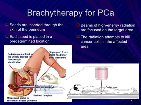 D de Jong, Prostate cancer brachytherapy