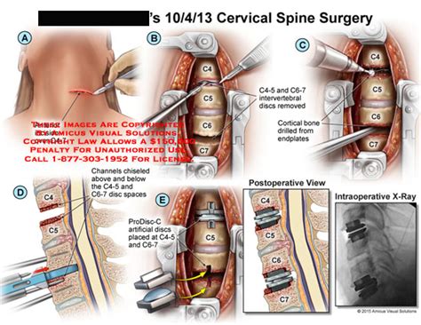 amicus,surgery,x-ray,cervical,spine,surgery,anterior,incision,c4,c5,c6 ...