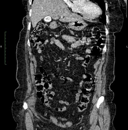 Gallstone ileus | Radiology Case | Radiopaedia.org