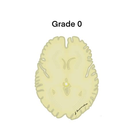 Modified Fisher scale | Radiology Case | Radiopaedia.org