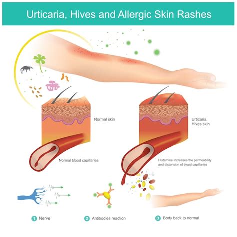 Premium Vector | Urticaria, hives and allergic skin rashes is a kind of ...