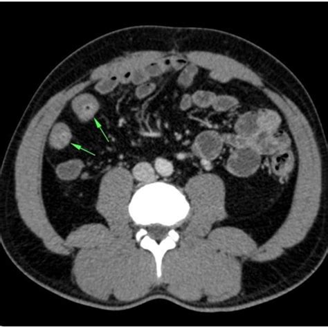 Ileocolic resection showing an edematous terminal ileum with... | Download Scientific Diagram