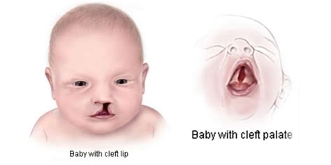 Facts about Cleft Lip and Cleft Palate | Birth Defects | NCBDDD | CDC