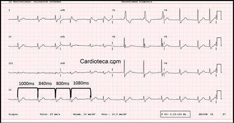 BLOQUEO NODAL SINOAURICULAR PDF